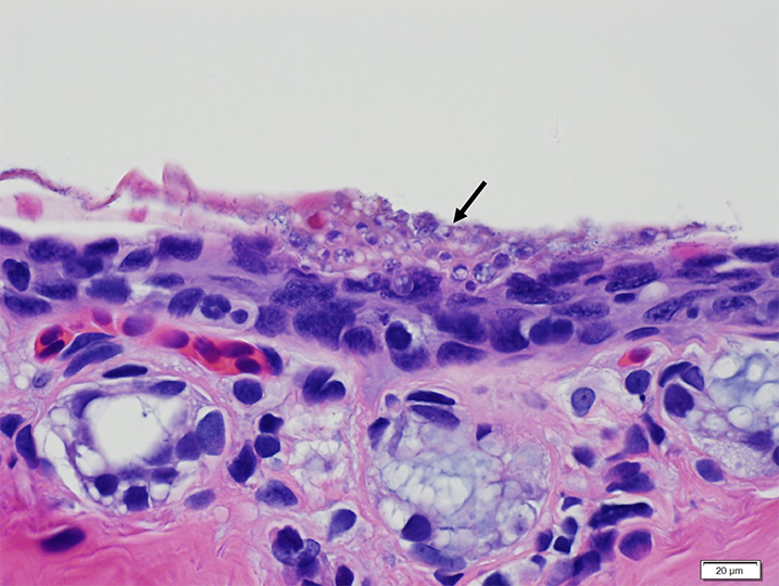 Histopathology confirms the presence of Bsal chytridiomycosis, shown with a black arrow.