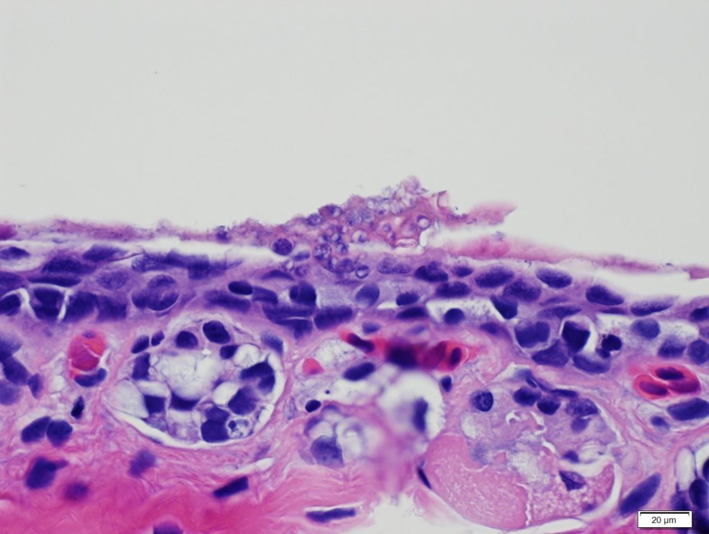 Histopathology of shallow lesion on a Blue Ridge two-lined salamander.